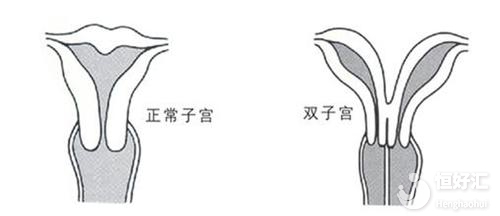 注意！子宮畸形正危及你的 “好孕”?！